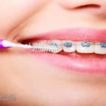 Benefits of orthodontic treatments for dental alignment