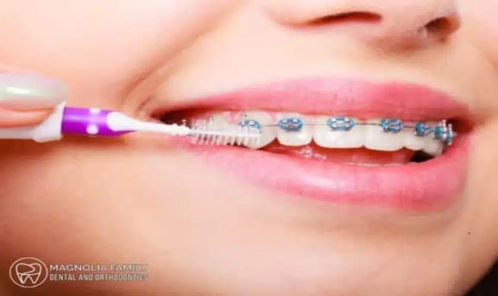 Benefits of orthodontic treatments for dental alignment
